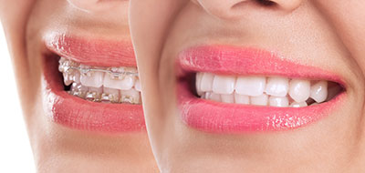 Granger Dentistry | Full Mouth Reconstruction, Teeth Whitening and Snoring Appliances
