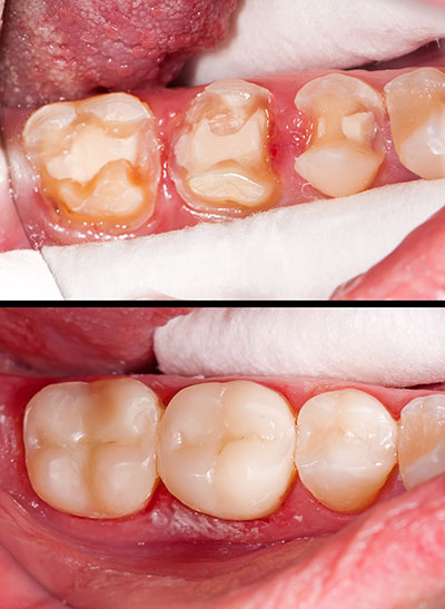 Granger Dentistry | Dentures, All-on-6 reg  and Night Guards