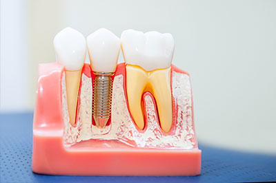 Granger Dentistry | Crowns  amp  Caps, Digital Impressions and Dental Fillings