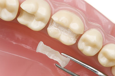 Granger Dentistry | Sleep Apnea, All-on-6 reg  and Dental Cleanings