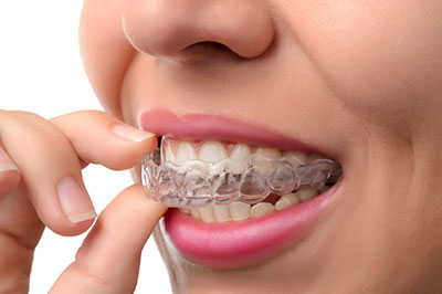 Granger Dentistry | Botox reg , Inlays  amp  Onlays and Veneers