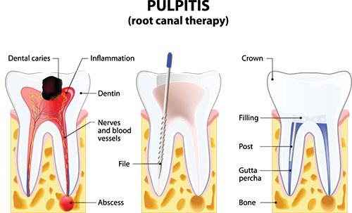 Granger Dentistry | Inlays  amp  Onlays, Preventative Program and Night Guards