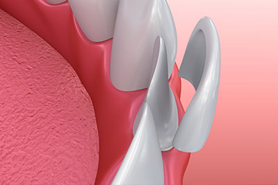 Granger Dentistry | Ceramic Crowns, Botox reg  and Oral Cancer Screening
