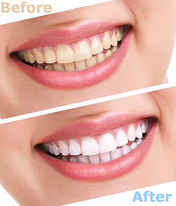 Granger Dentistry | Juvederm reg , Dental Sealants and Botox reg 