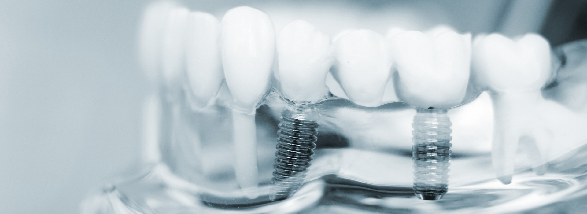Granger Dentistry | TMJ Disorders, Air Abrasion and Implant Dentistry