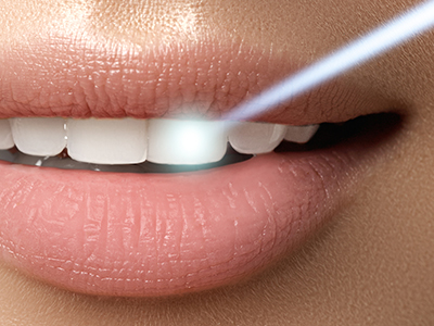 Granger Dentistry | ClearCorrect reg , Laser Dentistry and Inlays  amp  Onlays